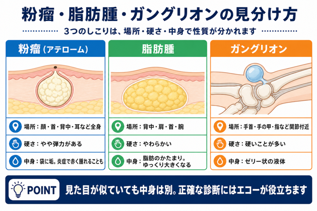 粉瘤、脂肪腫、ガングリオンの見分け方